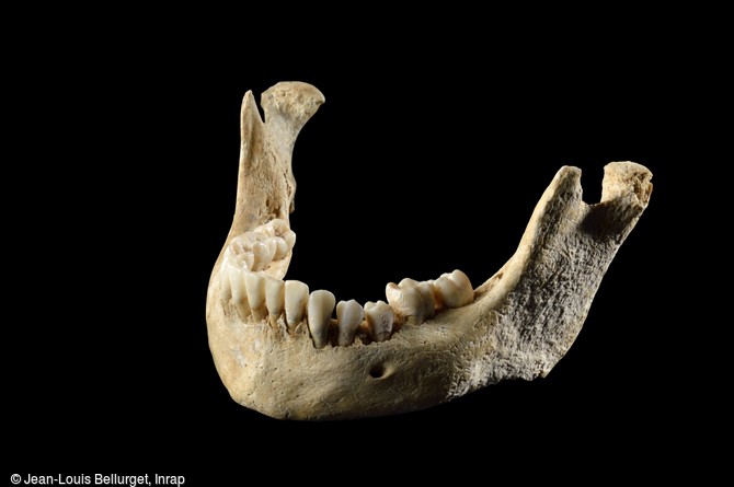 Mâchoire inférieure d'un crâne humain déformé, découvert à Obernai (Bas-Rhin), fin du IVe-début du Ve siècle. Cette pratique volontaire consiste à le ligaturer dès le jeune âge, à l'aide de planchettes et de bandages, comme en Asie centrale chez les Huns ou les Alains. Elle est aussi adoptée par les peuples germaniques en Europe (Burgondes, Alamans) à la suite des migrations, comme ici en Alsace.