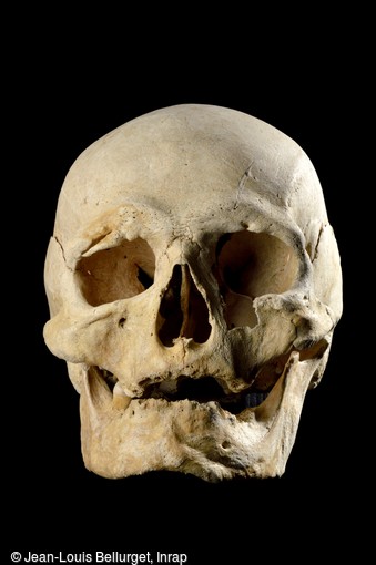 Cr&acirc;ne du VIIIe-IXe si&egrave;cle, mis au jour dans une tombe &agrave; Noisy-le-Grand (Seine-Saint-Denis). Au niveau de l'arcade sourcili&egrave;re droite, un petit bout d'os a &eacute;t&eacute; arrach&eacute;, coup&eacute; et s'est en partie ressoud&eacute; au reste du cr&acirc;ne.