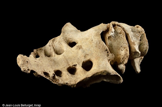 Vert&egrave;bres, VIIIe si&egrave;cle, provenant d'une tombe &agrave; Noisy-le-Grand (Seine-Saint-Denis). Cette colonne vert&eacute;brale pr&eacute;sente une l&eacute;sion li&eacute;e &agrave; un rhumatisme inflammatoire. Le sujet, tr&egrave;s handicap&eacute;, ne pouvait plus du tout plier le dos. 