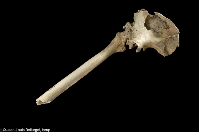 F&eacute;mur et os du bassin, IXe-Xe si&egrave;cle, d&eacute;couvert dans le cimeti&egrave;re m&eacute;di&eacute;val de Villemomble (Seine-Saint-Denis). L'activit&eacute;, l'&acirc;ge et de mauvaises habitudes ont provoqu&eacute; une ossification de ces deux os entre eux. cet individu avait du mal &agrave; marcher.