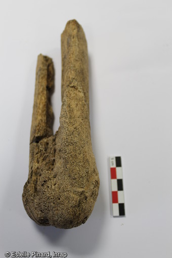 D&eacute;tail de l'amputation d'un pied droit : extr&eacute;mit&eacute; distale du tibia et de la fibula. Le squelette de cet individu a &eacute;t&eacute; mis au jour dans une s&eacute;pulture de l'&eacute;poque carolingienne (VIIIe-IXe si&egrave;cle) dans le ch&oelig;ur de l'&eacute;glise Sainte-Benoite de Lerzy (Aisne)